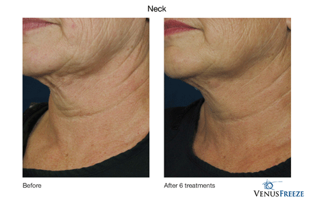 Images showing the results both before and after visiting Celebrity Medical Spa. As you can see there is a distinct differnce after several treatments. Beaverton, Oregon 97007.