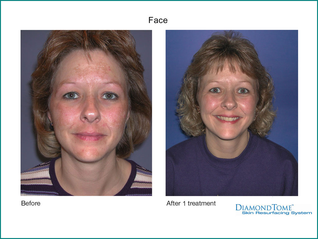 Skin Rejuvenation done by our friendly staff at Celebrity Spa of Beaverton, Oregon 97007