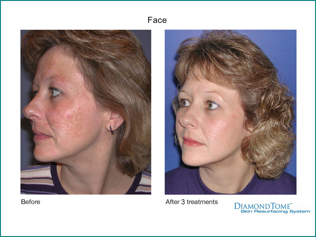 Skin Rejuvenation done by our friendly staff at Celebrity Spa of Beaverton, Oregon 97007