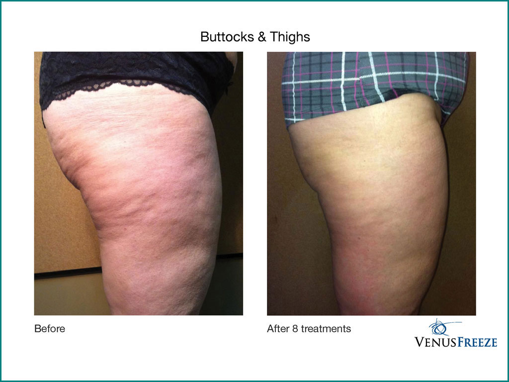 Body Contouring & Cellulite Reduction - done by our friendly staff at Celebrity Spa of Beaverton, Oregon 97007
