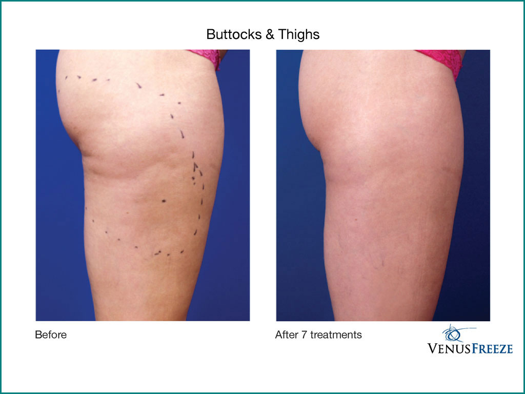 Skin Tightening & Cellulite Reduction - done by our friendly staff at Celebrity Spa of Beaverton, Oregon 97007